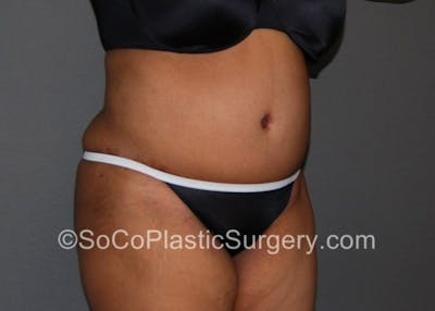 Tummy Tuck Before & After Gallery - Patient 8286184 - Image 4