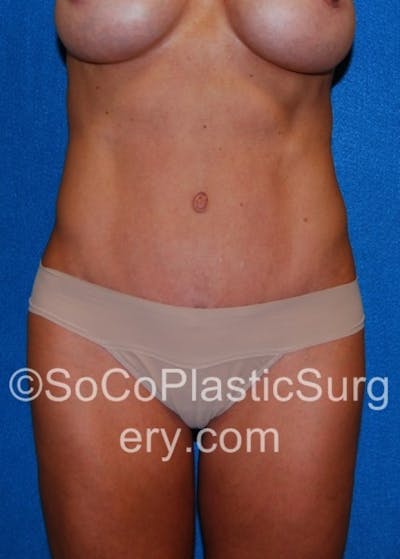 Tummy Tuck Before & After Gallery - Patient 8286185 - Image 2