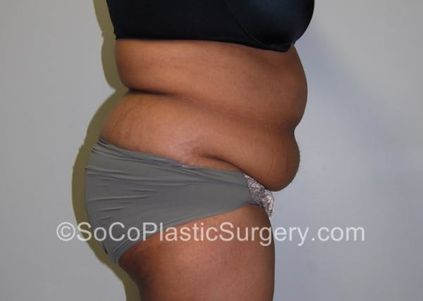 Tummy Tuck Gallery - Patient 8286184 - Image 5