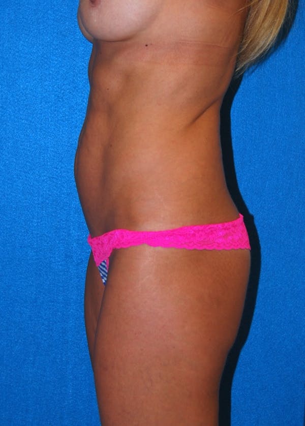 Tummy Tuck Before & After Gallery - Patient 8286185 - Image 3