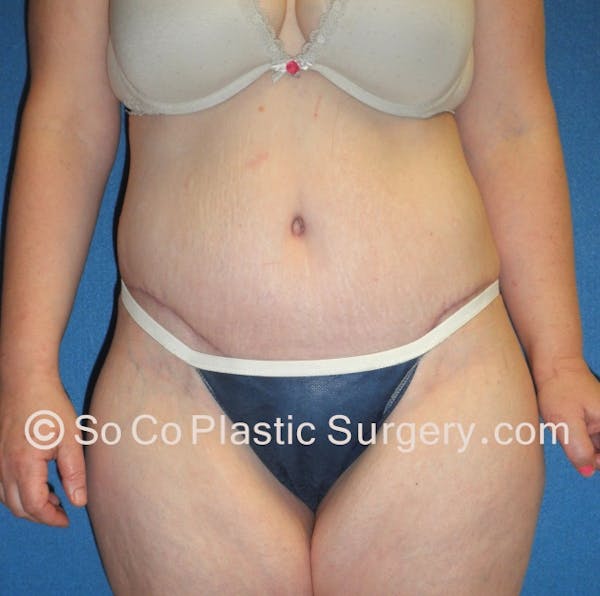 Tummy Tuck Before & After Gallery - Patient 8286186 - Image 2
