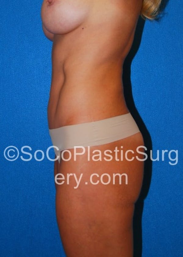 Tummy Tuck Before & After Gallery - Patient 8286185 - Image 4