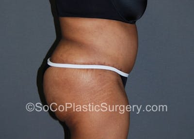 Tummy Tuck Before & After Gallery - Patient 8286184 - Image 6