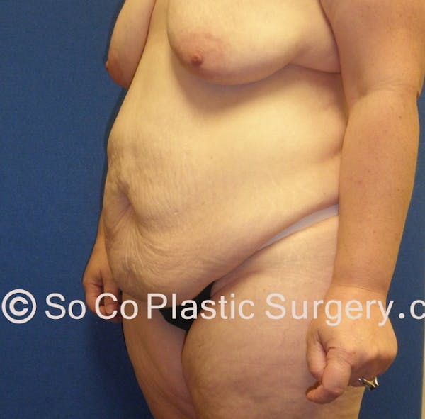 Tummy Tuck Before & After Gallery - Patient 8286186 - Image 3