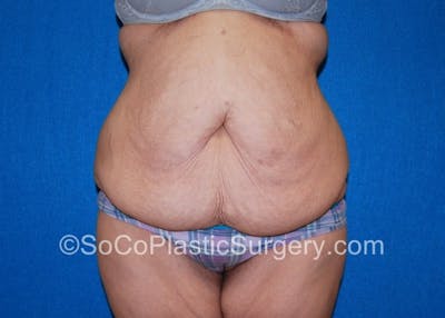 Tummy Tuck Before & After Gallery - Patient 8286187 - Image 1