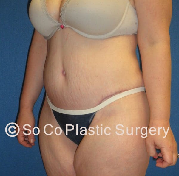 Tummy Tuck Before & After Gallery - Patient 8286186 - Image 4