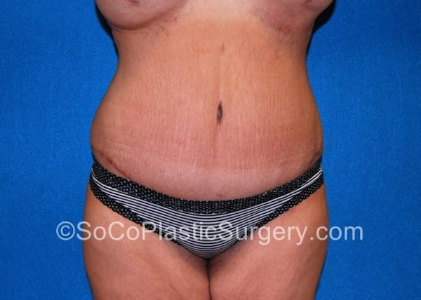 Tummy Tuck Before & After Gallery - Patient 8286187 - Image 2