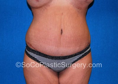 Tummy Tuck Before & After Gallery - Patient 8286187 - Image 2
