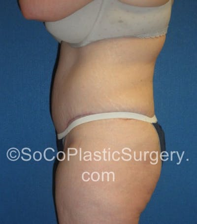 Tummy Tuck Before & After Gallery - Patient 8286186 - Image 6