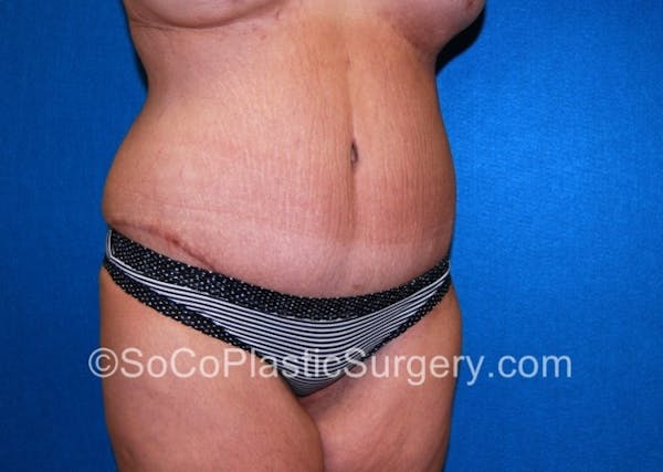 Tummy Tuck Before & After Gallery - Patient 8286187 - Image 4