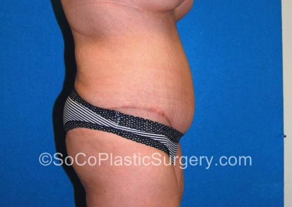 Tummy Tuck Gallery - Patient 8286187 - Image 6