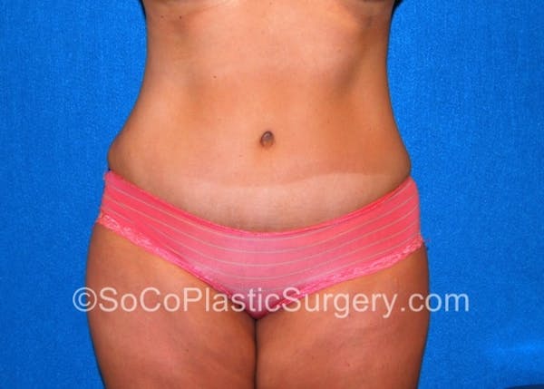 Tummy Tuck Before & After Gallery - Patient 8286188 - Image 4