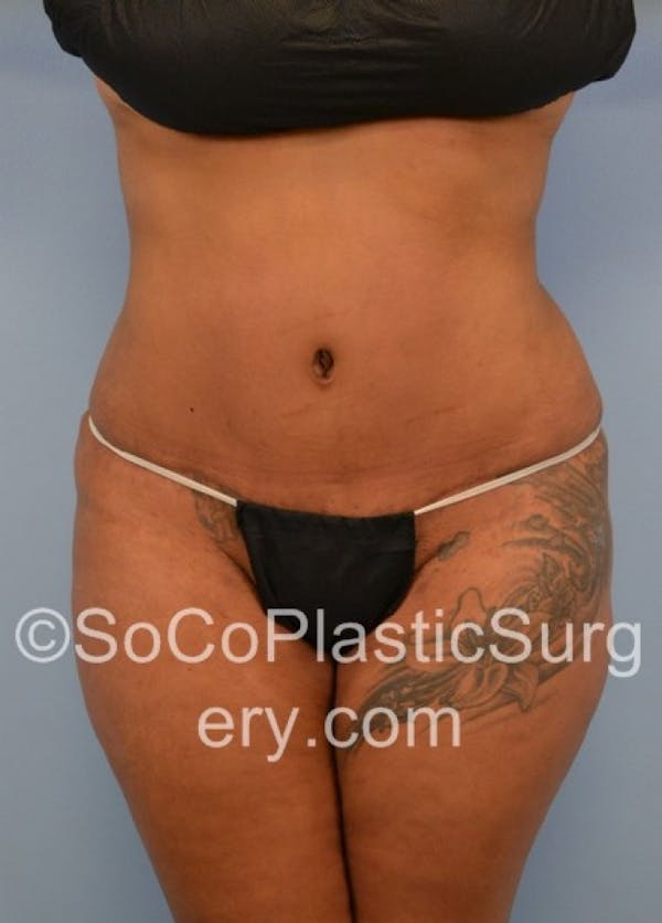 Tummy Tuck Before & After Gallery - Patient 8286189 - Image 2