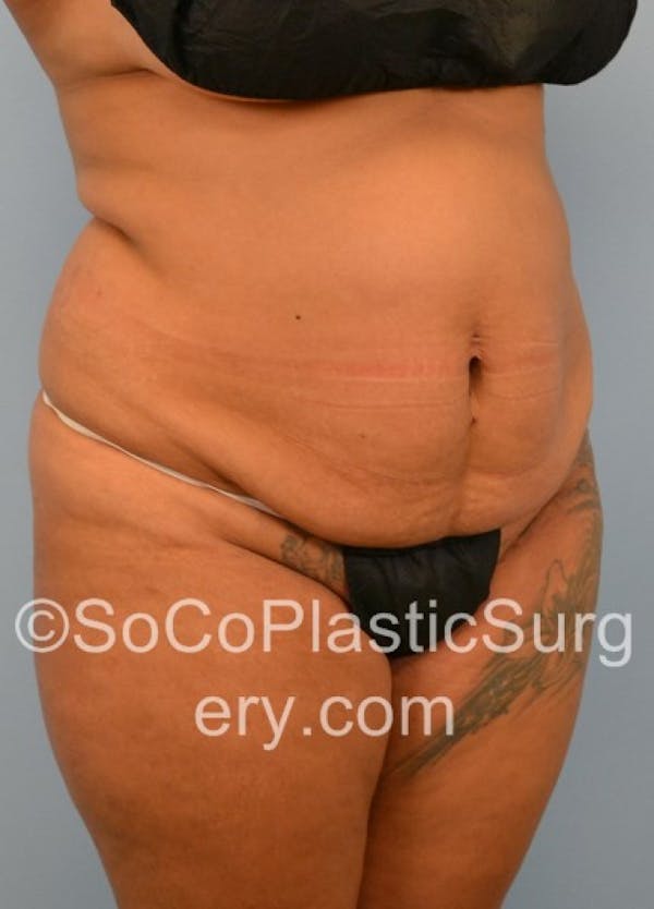 Tummy Tuck Before & After Gallery - Patient 8286189 - Image 3