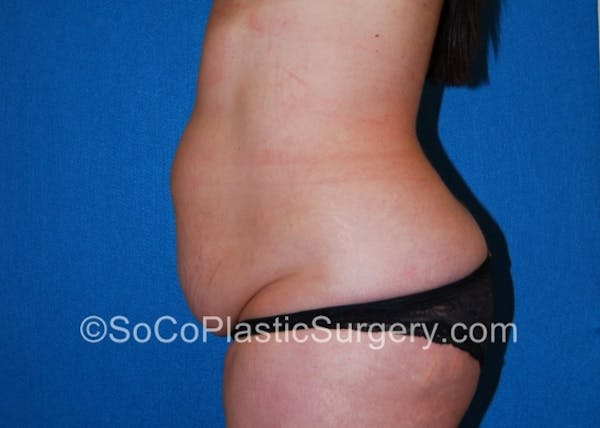 Tummy Tuck Before & After Gallery - Patient 8286188 - Image 7
