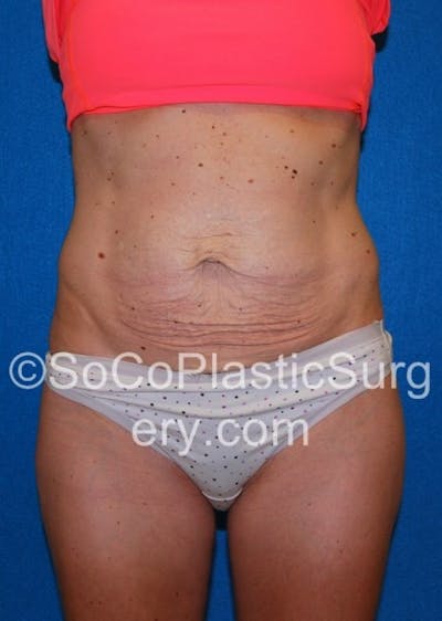 Tummy Tuck Before & After Gallery - Patient 8286190 - Image 1