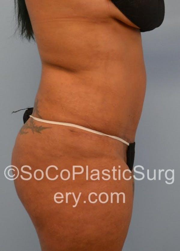Tummy Tuck Before & After Gallery - Patient 8286189 - Image 6
