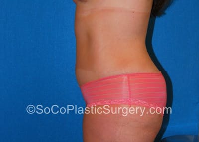 Tummy Tuck Before & After Gallery - Patient 8286188 - Image 8