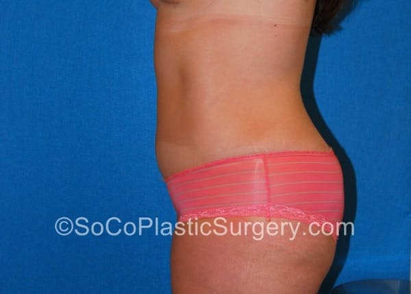 Tummy Tuck Before & After Gallery - Patient 8286188 - Image 8