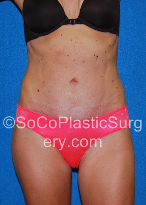 Tummy Tuck Before & After Gallery - Patient 8286190 - Image 2
