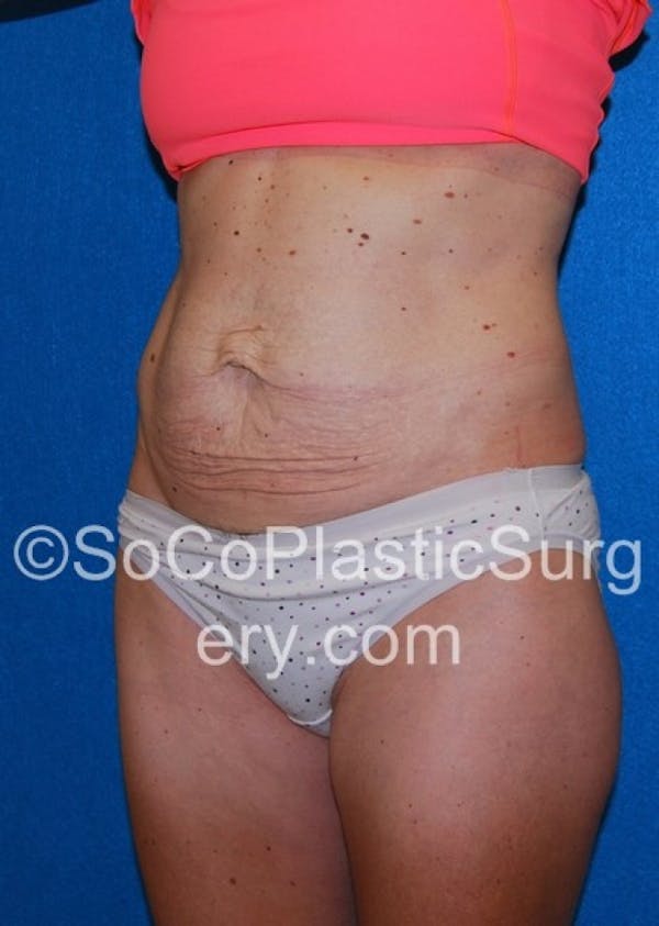 Tummy Tuck Before & After Gallery - Patient 8286190 - Image 3