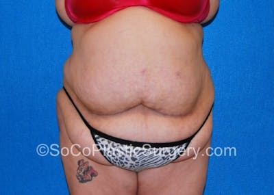 Tummy Tuck Before & After Gallery - Patient 8286191 - Image 1
