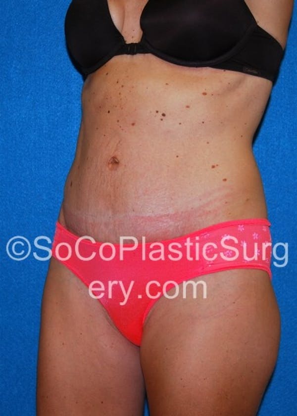 Tummy Tuck Before & After Gallery - Patient 8286190 - Image 4