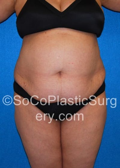 Tummy Tuck Before & After Gallery - Patient 8286192 - Image 1