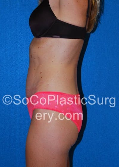 Tummy Tuck Before & After Gallery - Patient 8286190 - Image 6