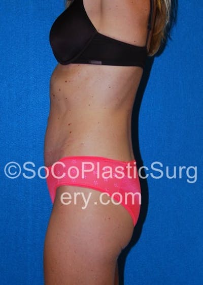 Tummy Tuck Gallery - Patient 8286190 - Image 6