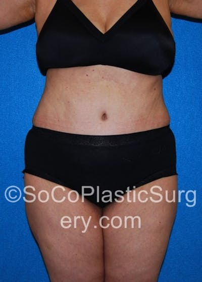 Tummy Tuck Before & After Gallery - Patient 8286192 - Image 2