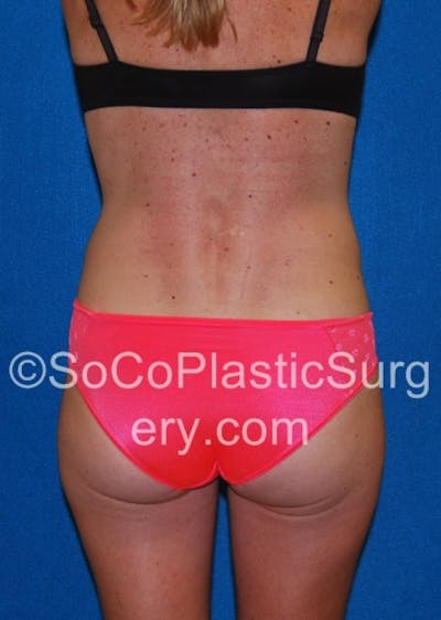 Tummy Tuck Gallery - Patient 8286190 - Image 8