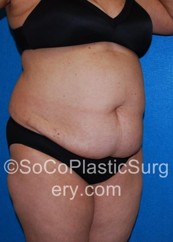 Tummy Tuck Before & After Gallery - Patient 8286192 - Image 3
