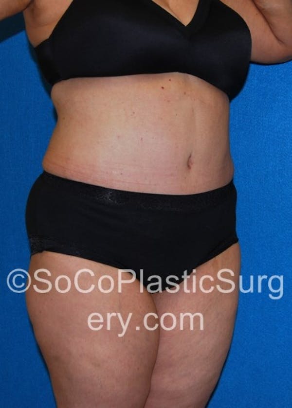 Tummy Tuck Before & After Gallery - Patient 8286192 - Image 4