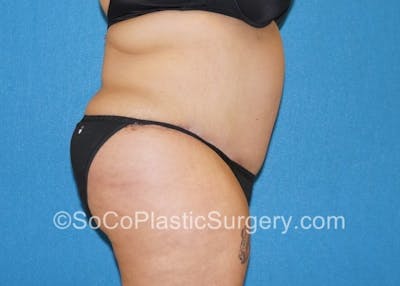 Tummy Tuck Before & After Gallery - Patient 8286191 - Image 6