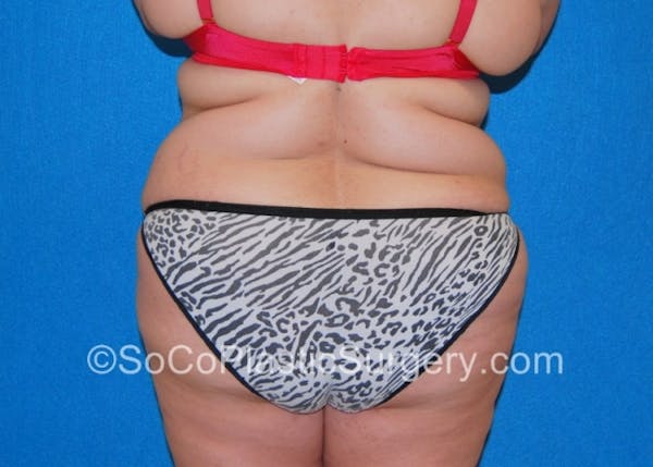 Tummy Tuck Before & After Gallery - Patient 8286191 - Image 7