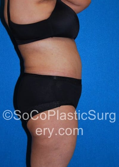 Tummy Tuck Before & After Gallery - Patient 8286192 - Image 6