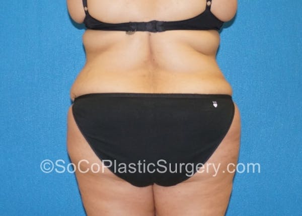 Tummy Tuck Gallery - Patient 8286191 - Image 8