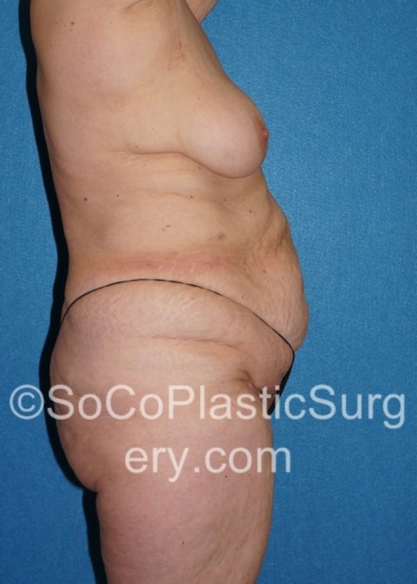 Tummy Tuck Before & After Gallery - Patient 8286193 - Image 5