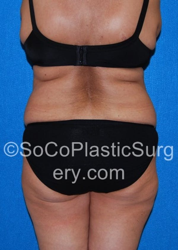 Tummy Tuck Before & After Gallery - Patient 8286192 - Image 7