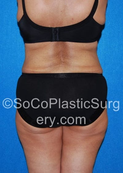 Tummy Tuck Gallery - Patient 8286192 - Image 8