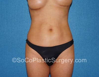 Tummy Tuck Before & After Gallery - Patient 8286194 - Image 1