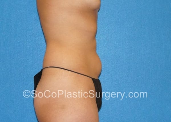 Tummy Tuck Gallery - Patient 8286195 - Image 3