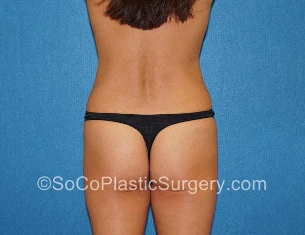Tummy Tuck Before & After Gallery - Patient 8286194 - Image 7
