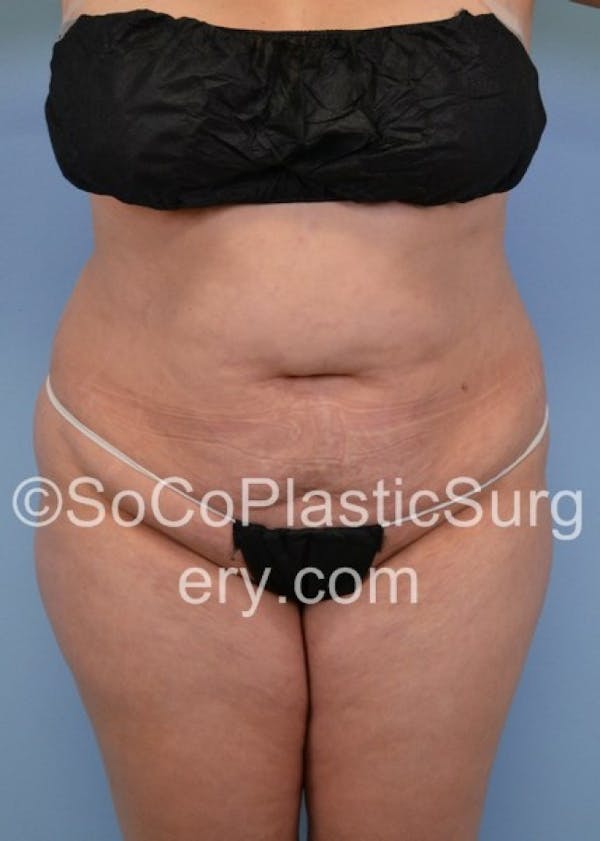 Tummy Tuck Before & After Gallery - Patient 8286196 - Image 1