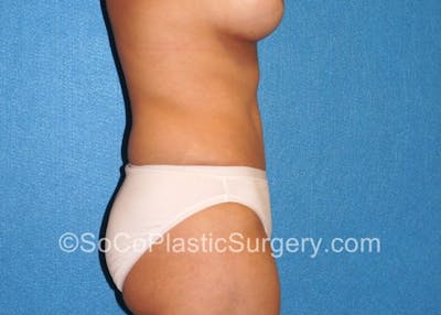 Tummy Tuck Before & After Gallery - Patient 8286195 - Image 4