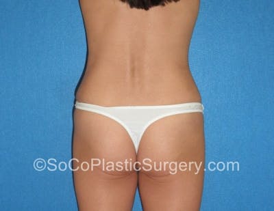 Tummy Tuck Before & After Gallery - Patient 8286194 - Image 8
