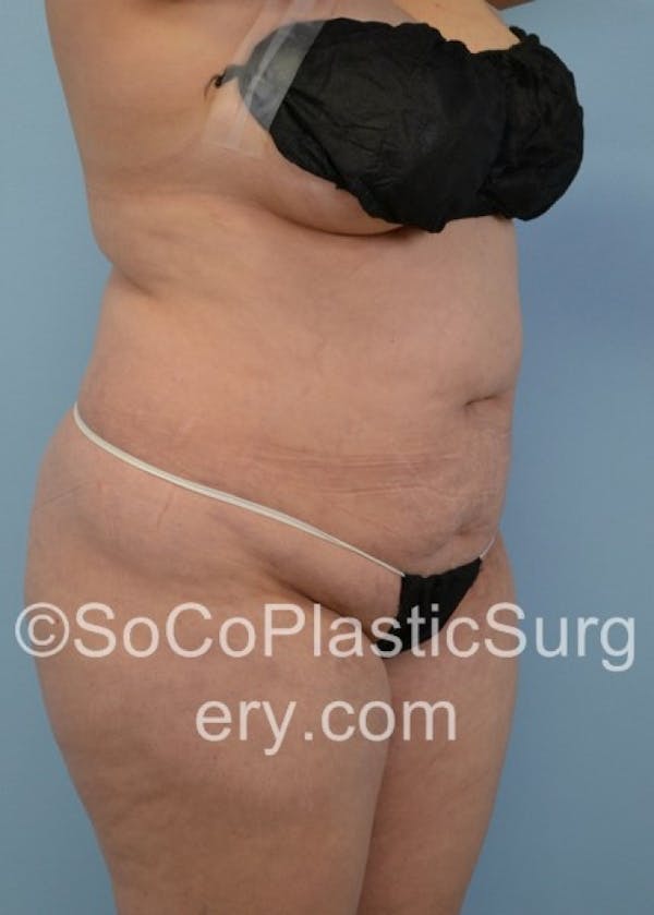 Tummy Tuck Before & After Gallery - Patient 8286196 - Image 3