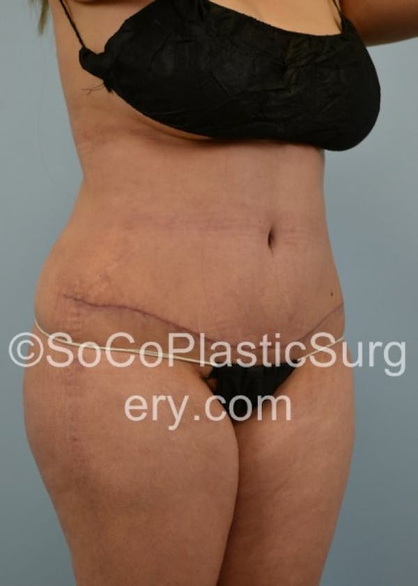 Tummy Tuck Before & After Gallery - Patient 8286196 - Image 4