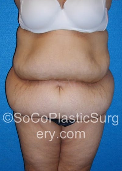 Tummy Tuck Before & After Gallery - Patient 8286197 - Image 1